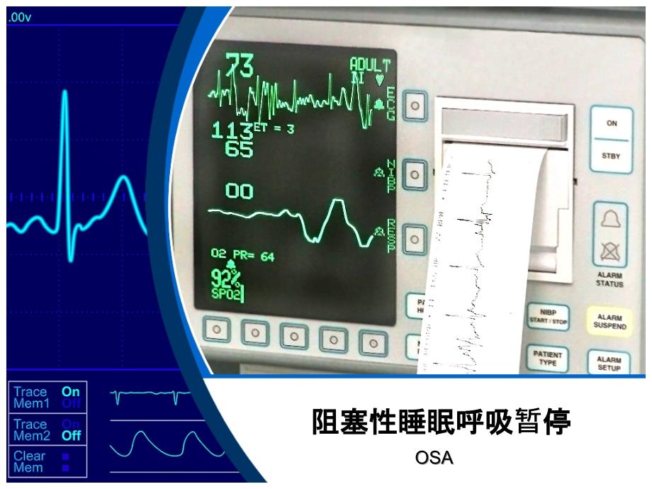 《OSAHS专家共识》PPT课件.ppt_第1页