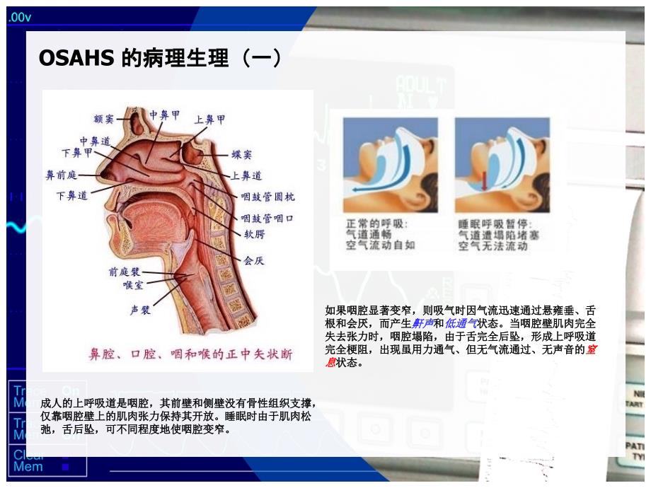 《OSAHS专家共识》PPT课件.ppt_第4页