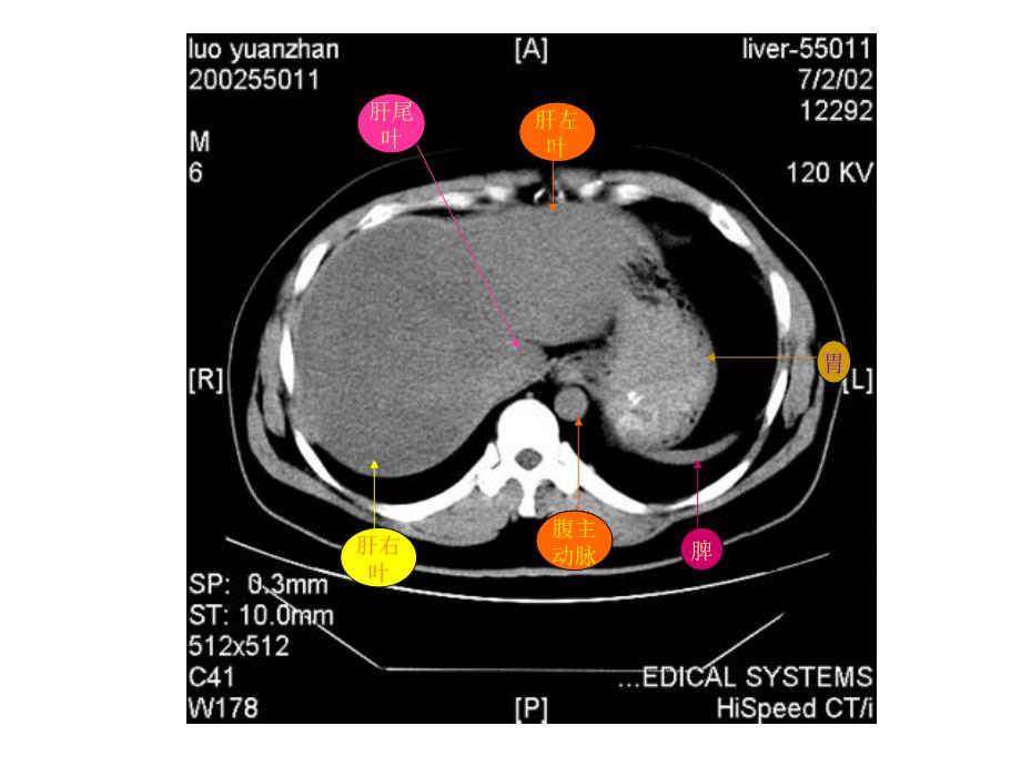 《腹部CT解剖图示》PPT课件.ppt_第3页
