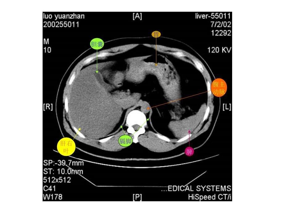 《腹部CT解剖图示》PPT课件.ppt_第5页
