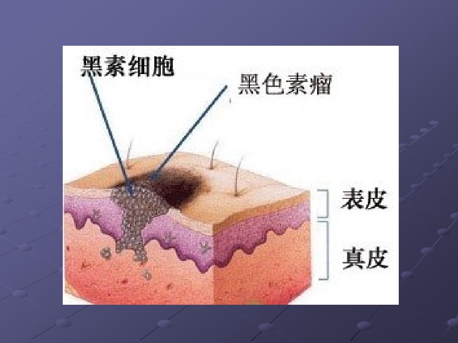 《恶性黑色素瘤》PPT课件.ppt_第4页