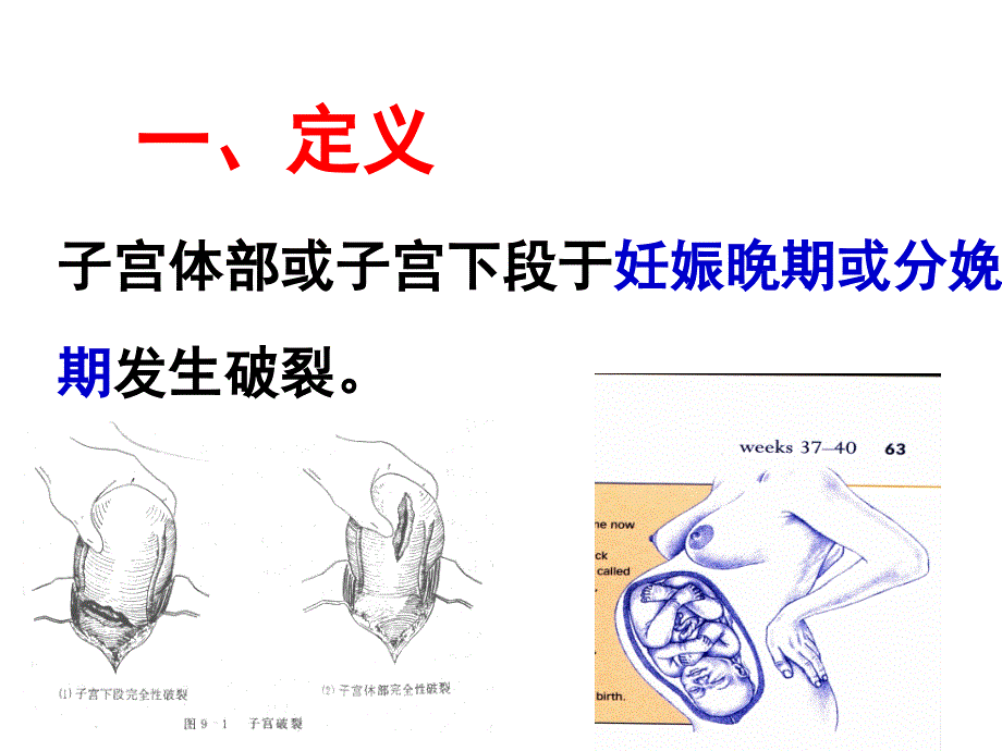 《子宫破裂精要》PPT课件.ppt_第2页