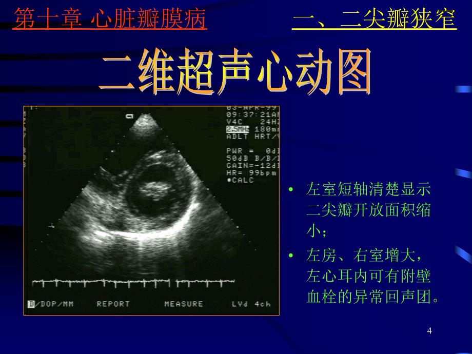 《心脏彩超诊断》PPT课件.ppt_第4页