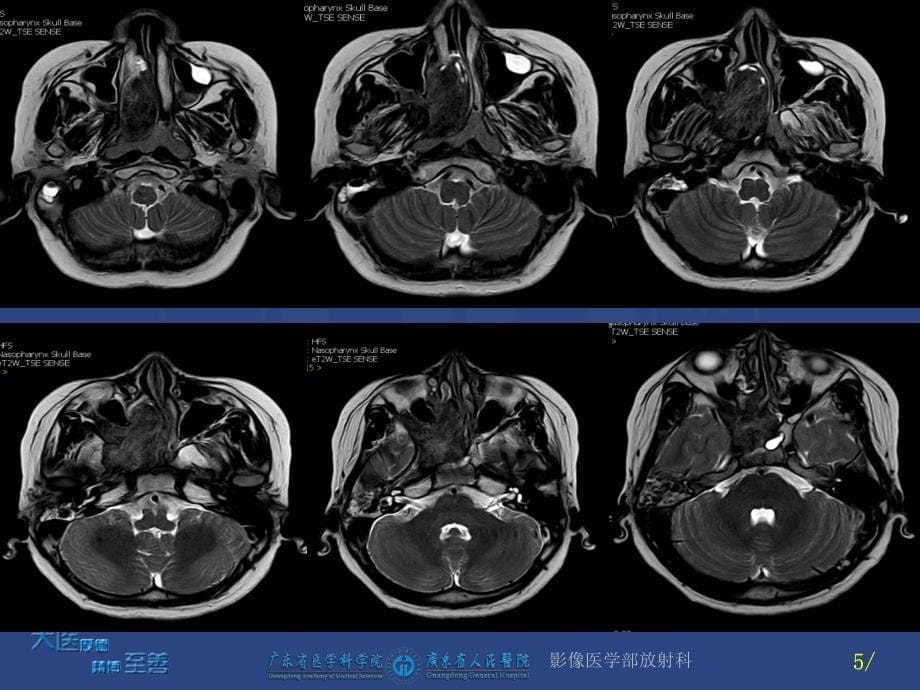 《鼻咽纤维血管瘤》PPT课件.ppt_第5页