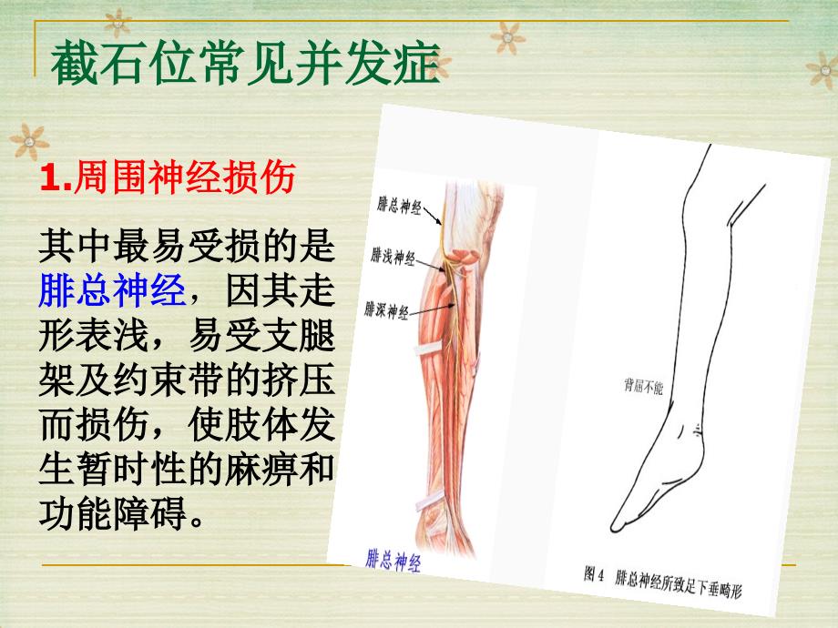 《截石位的摆放》PPT课件.ppt_第4页