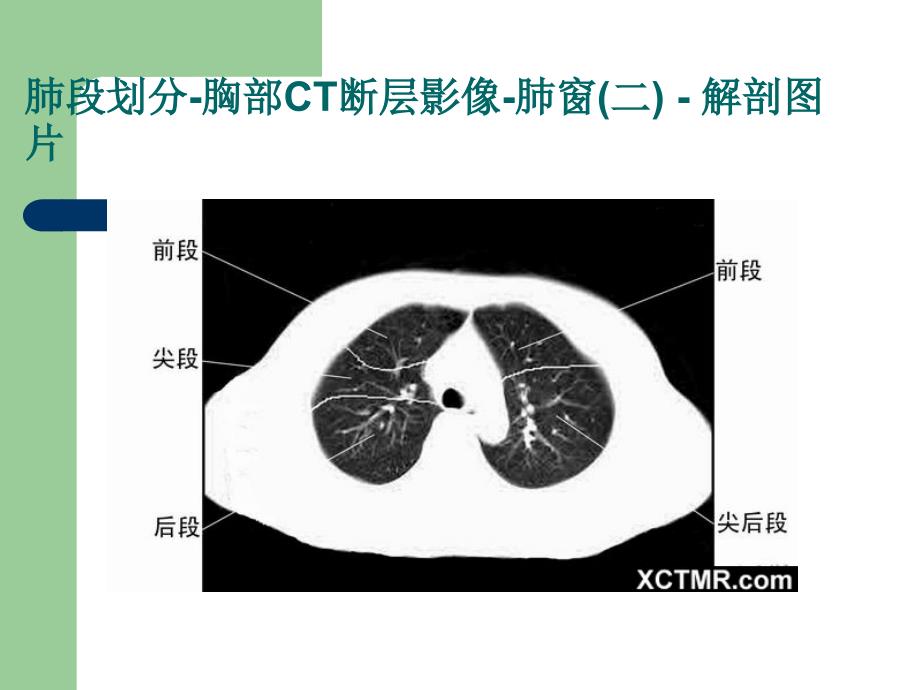 《胸腹部CT阅片》PPT课件.ppt_第4页