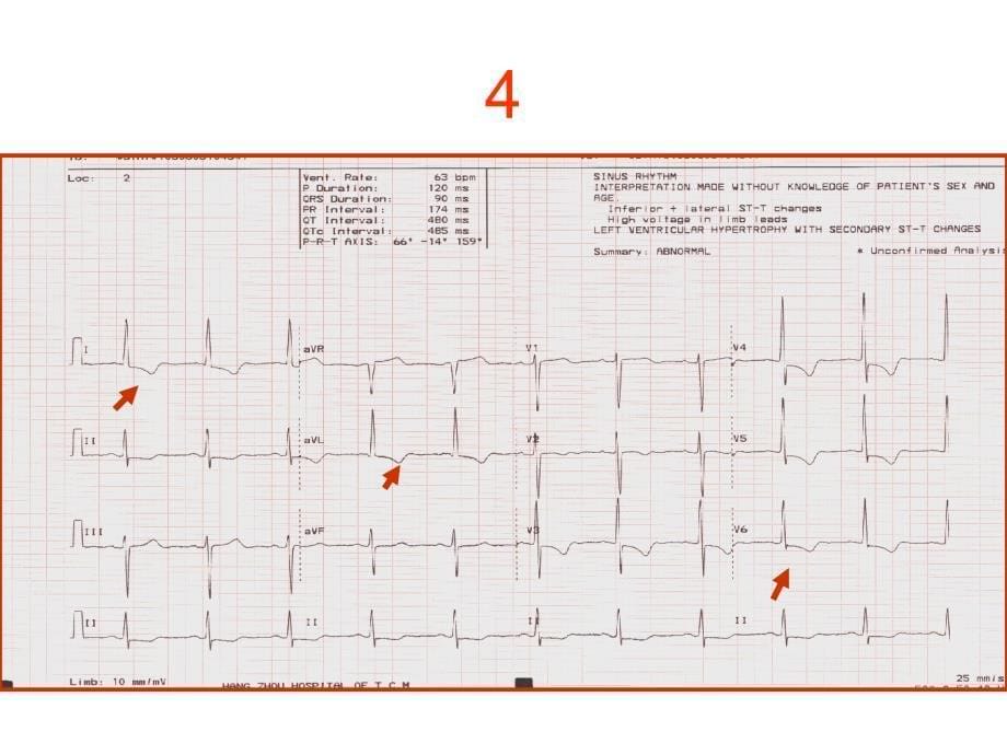 《心电图考核图谱》PPT课件.ppt_第5页
