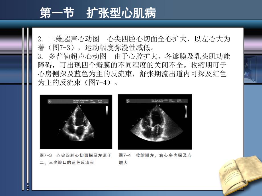 《心肌病超声诊断》PPT课件.ppt_第3页