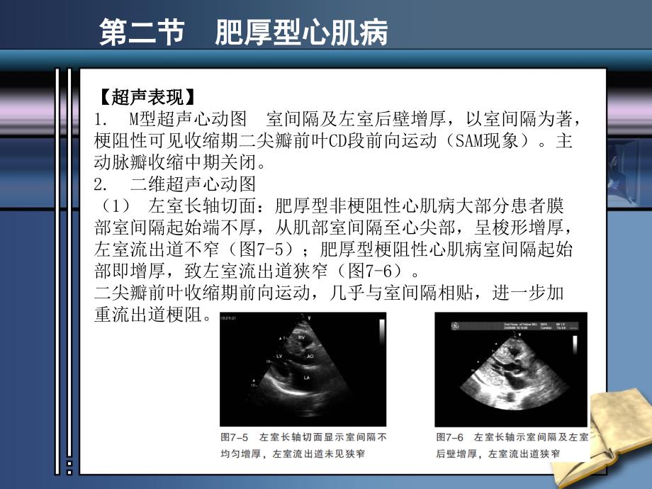 《心肌病超声诊断》PPT课件.ppt_第4页