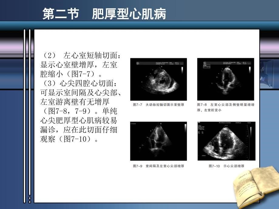 《心肌病超声诊断》PPT课件.ppt_第5页