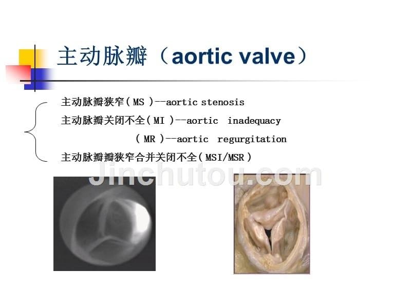 《心外科常见疾病》PPT课件.ppt_第5页