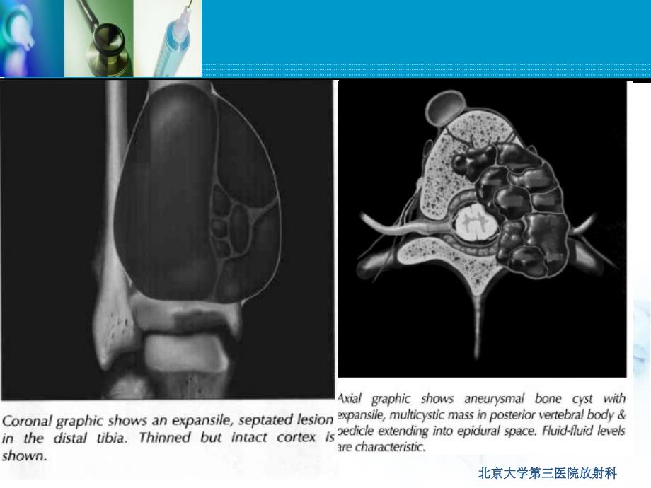 《动脉瘤样骨囊肿》PPT课件.ppt_第3页