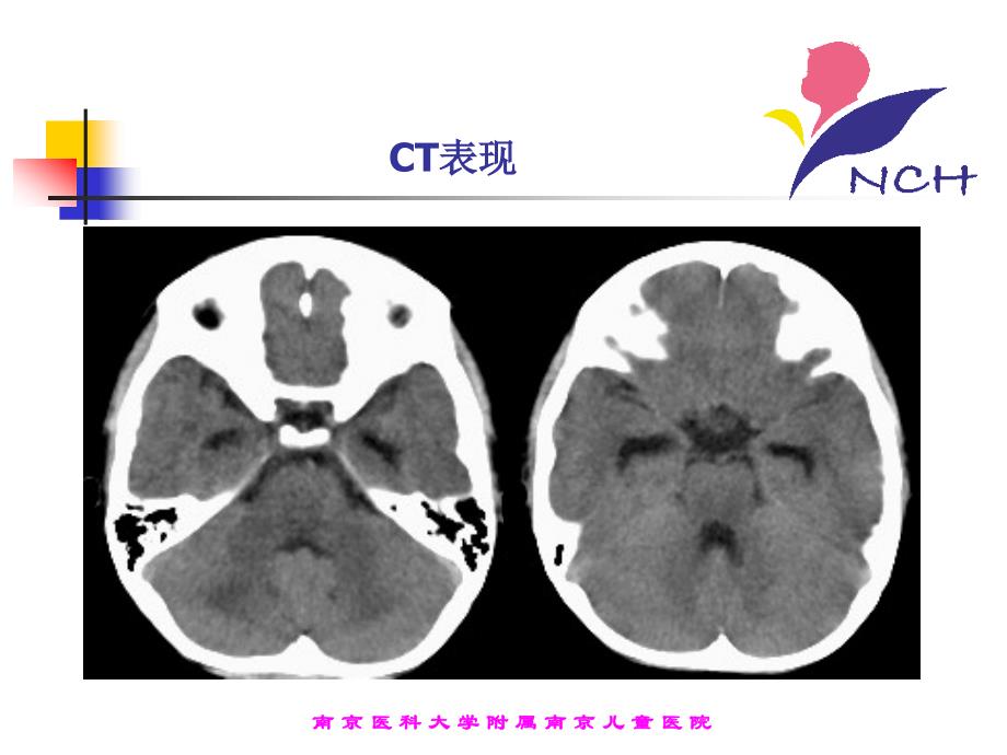 《儿童坏死性脑病》PPT课件.ppt_第4页