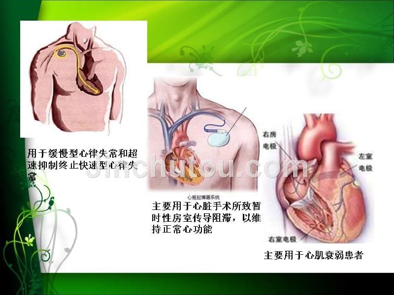 临时起搏器的护理完整版本.ppt_第5页