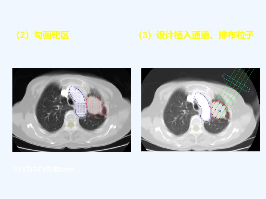 放射性粒子治疗肺癌存在问题与应对策略讲诉_第4页