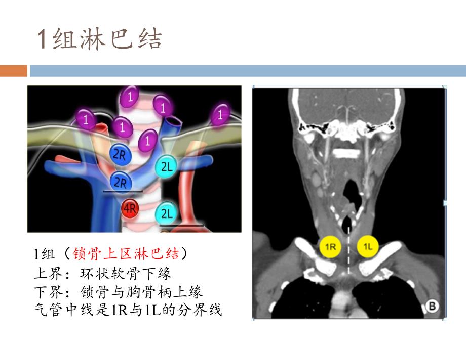 最新IASLC胸部淋巴结分组图谱解读ppt课件.pptx_第4页