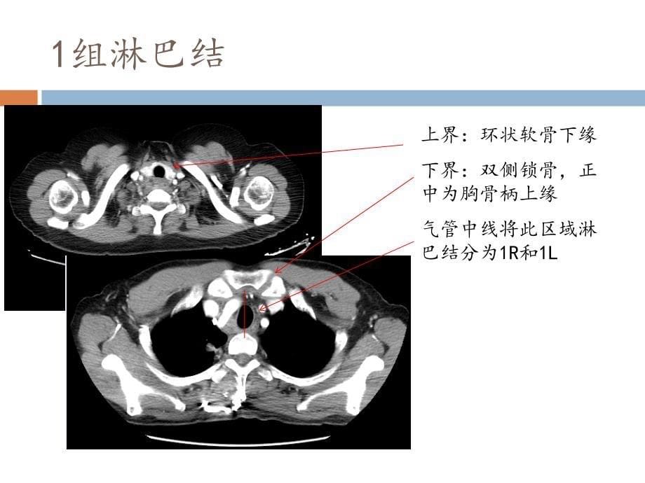 最新IASLC胸部淋巴结分组图谱解读ppt课件.pptx_第5页