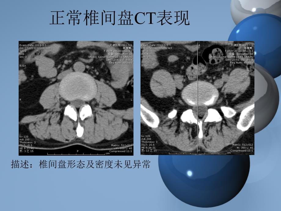 腰椎间盘突出描述医学PPT.ppt_第4页