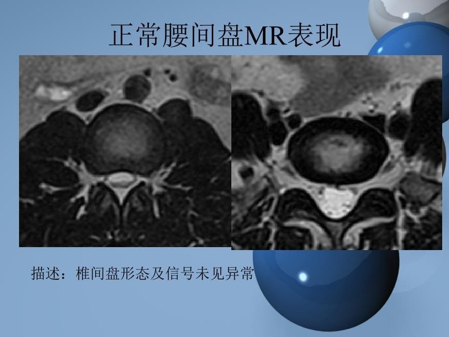 腰椎间盘突出描述医学PPT.ppt_第5页