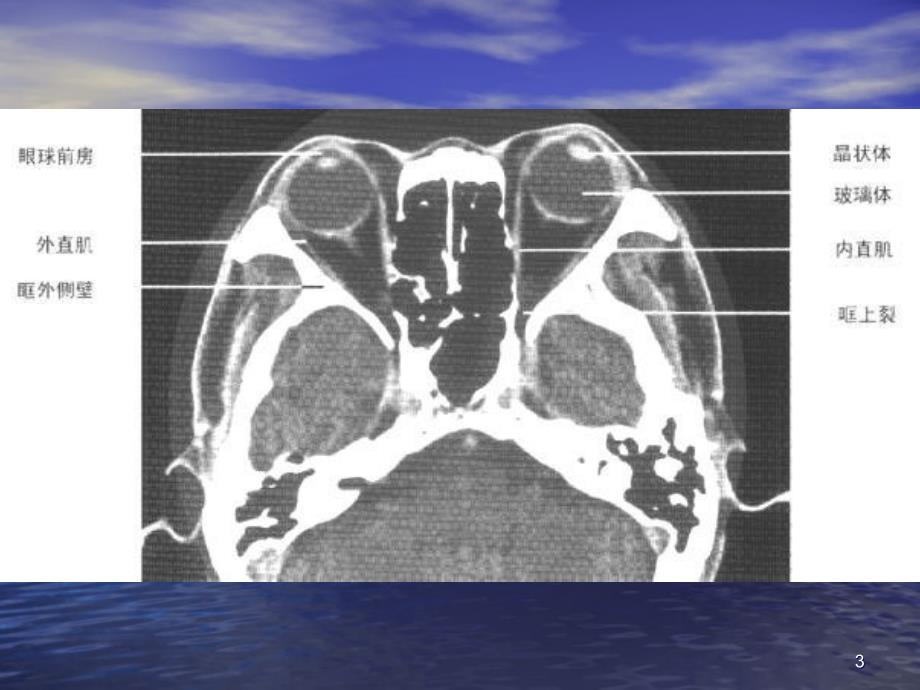 头颈部CT ppt课件.ppt_第3页