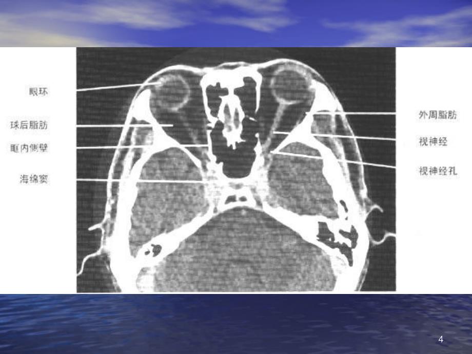头颈部CT ppt课件.ppt_第4页
