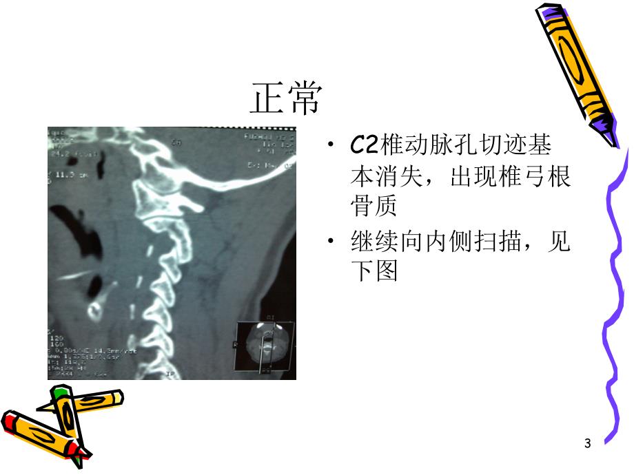 椎动脉高跨ppt课件.ppt_第3页