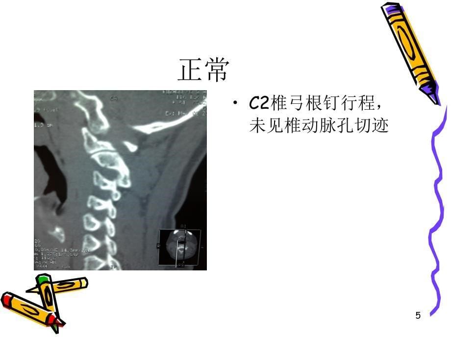 椎动脉高跨ppt课件.ppt_第5页