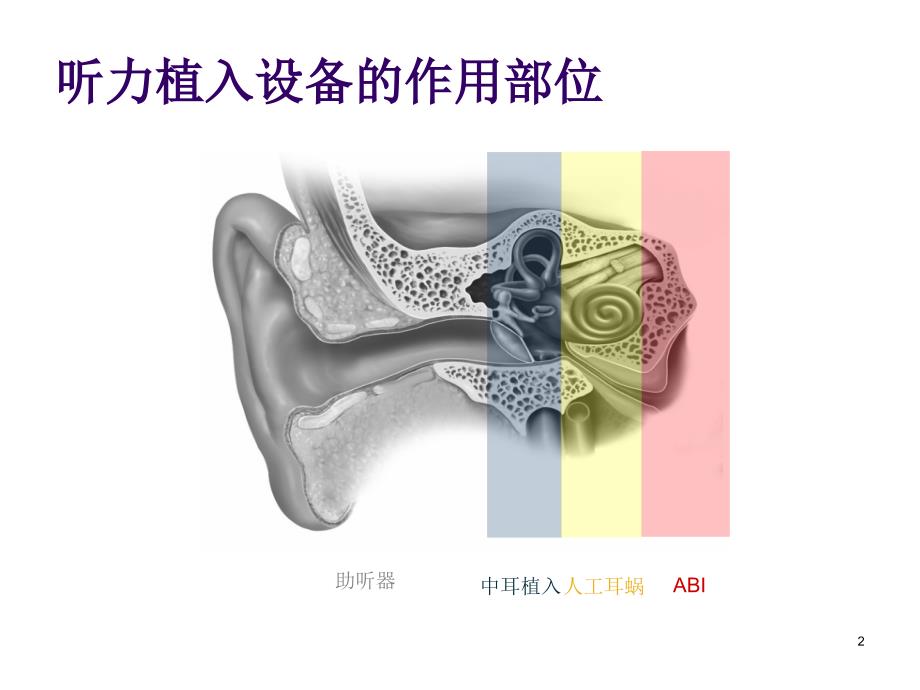 植入式听力系统PPT课件.ppt_第2页