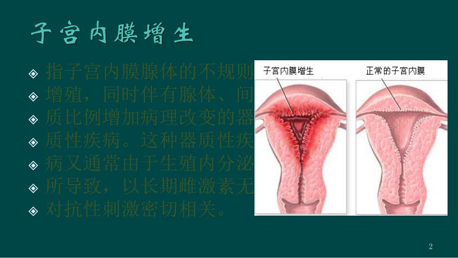 子宫内膜增生ppt课件.pptx_第2页
