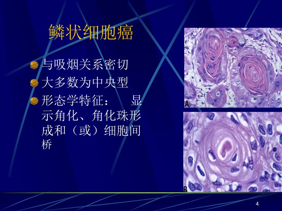 肺癌分类简介ppt课件.ppt_第4页