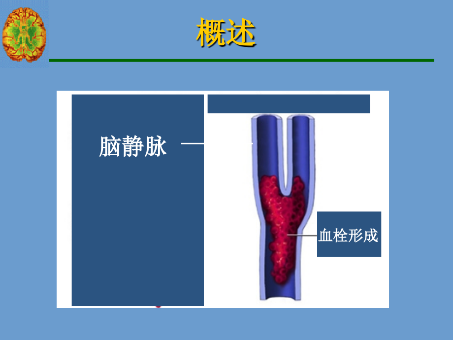 颅内静脉血栓形成PPT课件.ppt_第4页