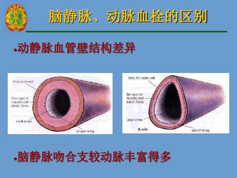 颅内静脉血栓形成PPT课件.ppt_第5页