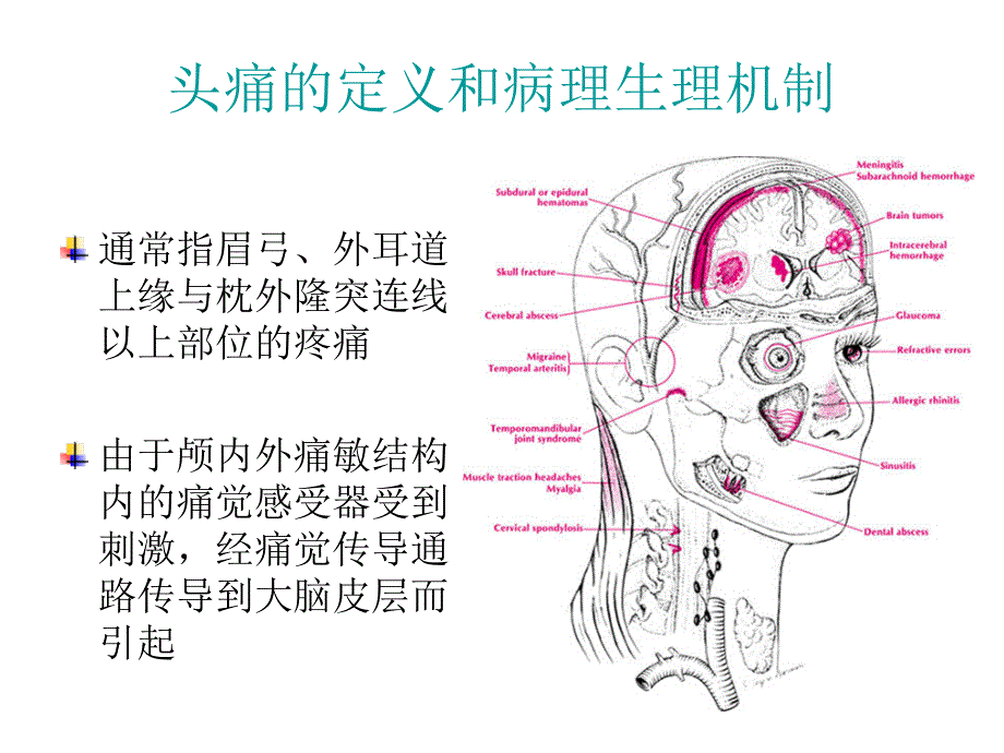 原发性头痛PPT课件.ppt_第2页