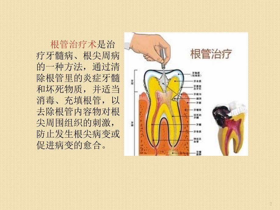 根管治疗的护理ppt课件.ppt_第2页