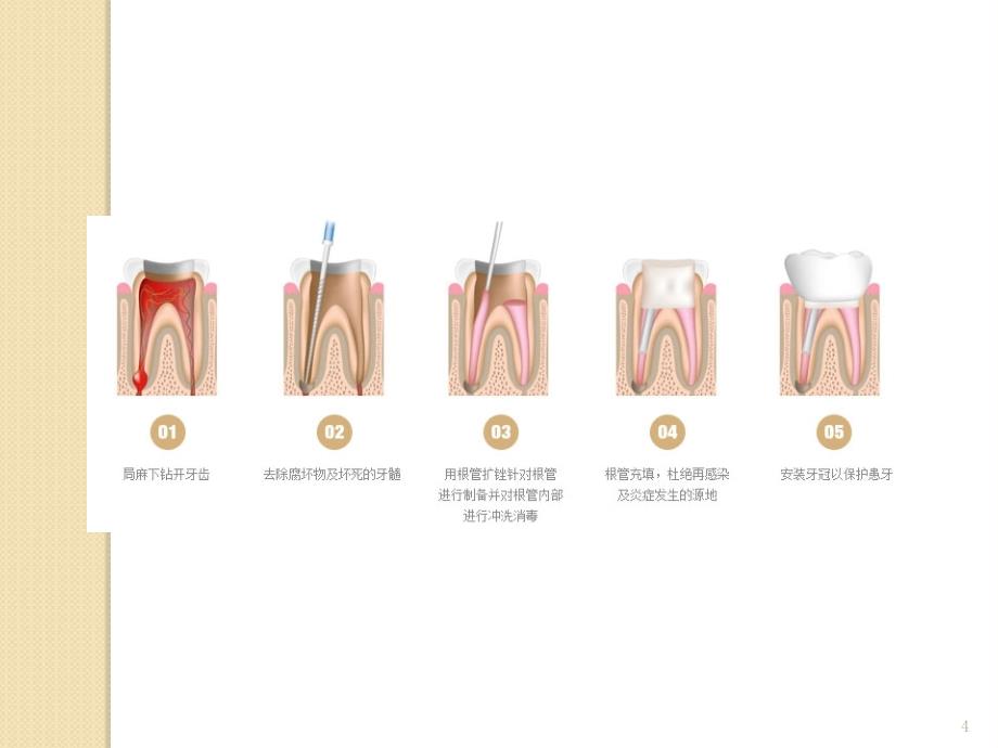 根管治疗的护理ppt课件.ppt_第4页