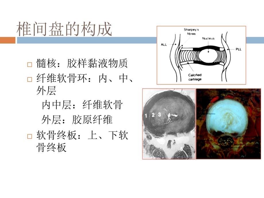 椎间盘突出的影像学诊断PPT课件.ppt_第5页