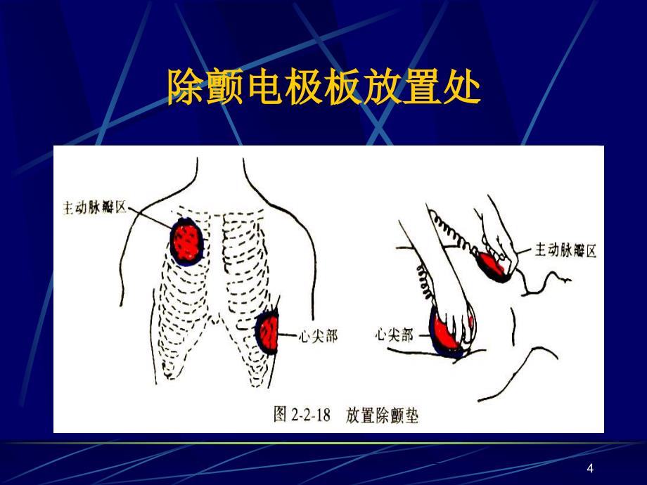 心脏电复律技术ppt课件.ppt_第4页