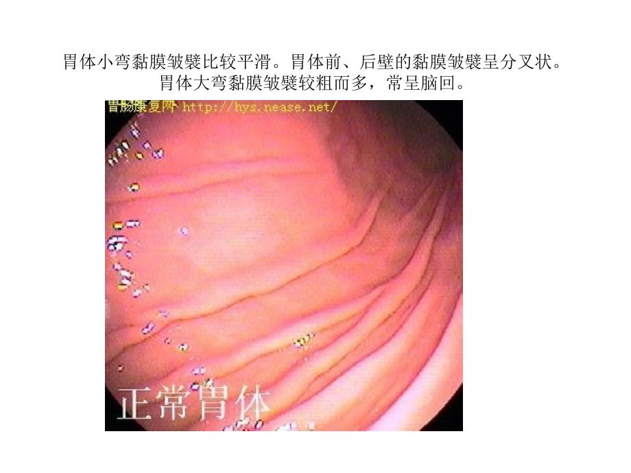 正常胃肠镜图片_第3页