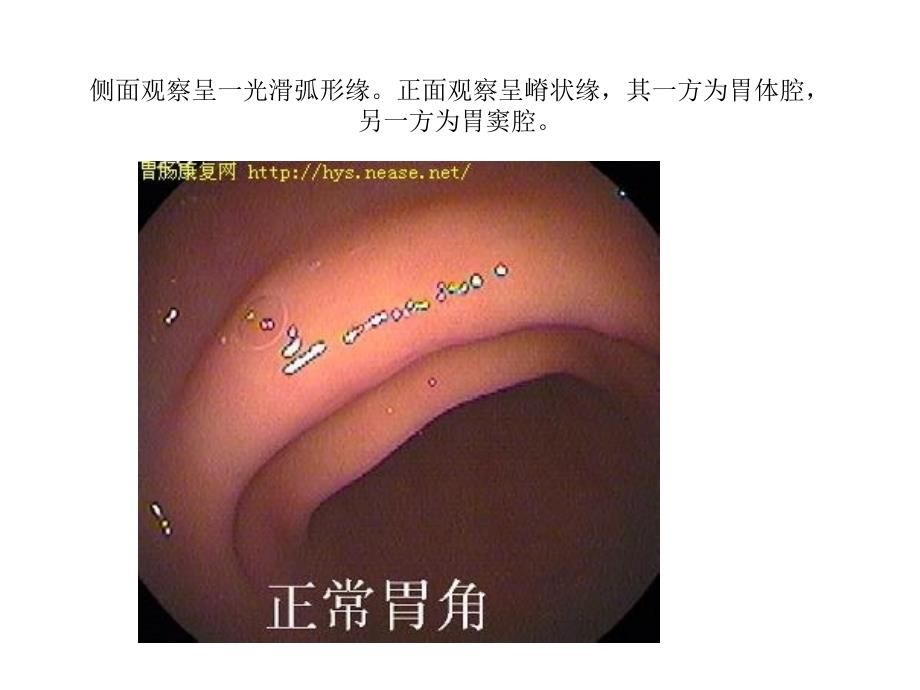 正常胃肠镜图片_第4页