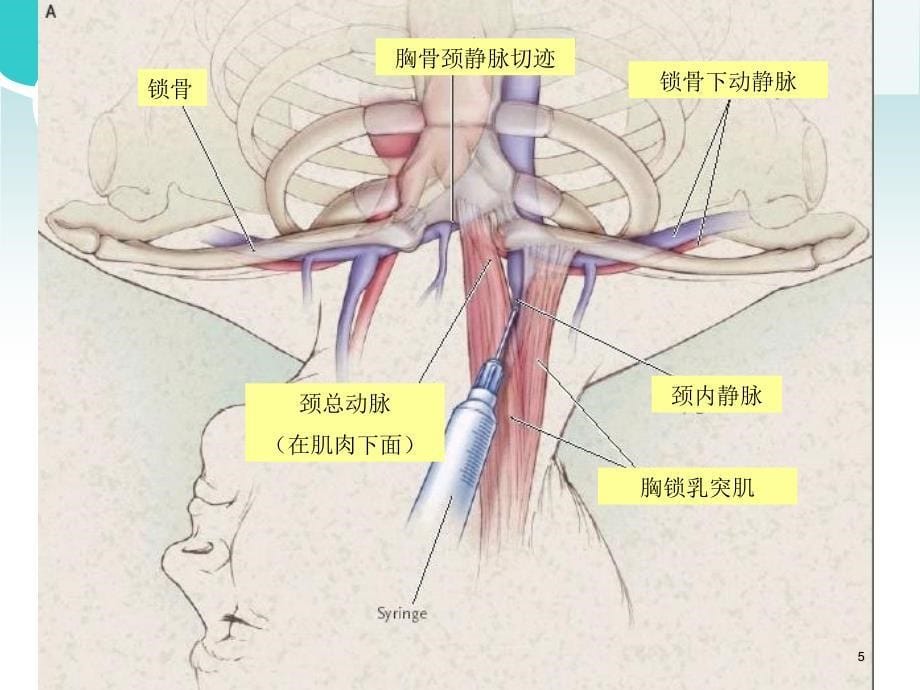 深静脉穿刺ppt课件.ppt_第5页