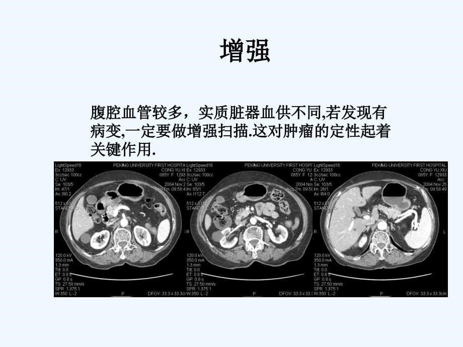 医学影像诊断腹部影像诊断学_第5页