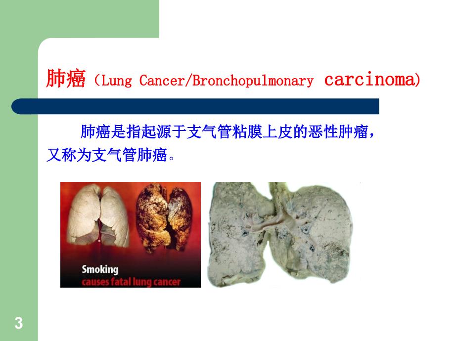 肺癌的早期诊断与防治ppt课件.ppt_第3页