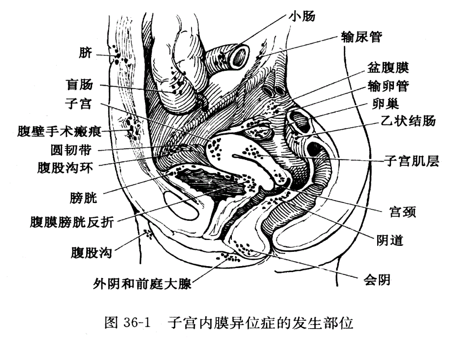 子宫脱垂内膜异位医学幻灯片.ppt_第3页