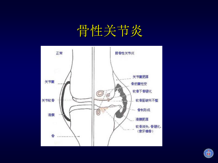 膝关节骨性关节炎的分级治疗完整.ppt_第3页