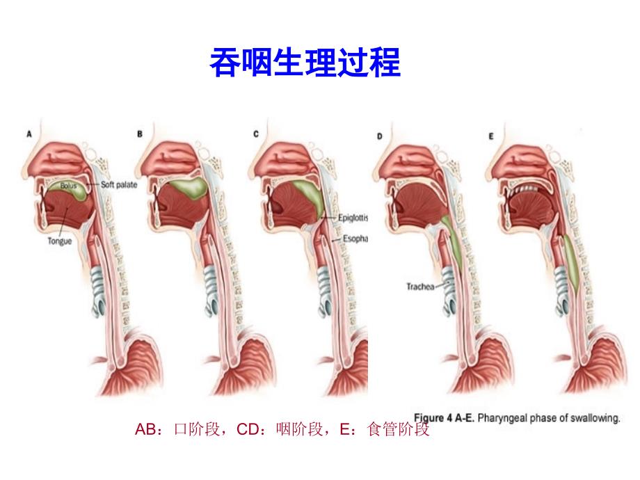 吞咽障碍的康复护理完整版本.ppt_第4页