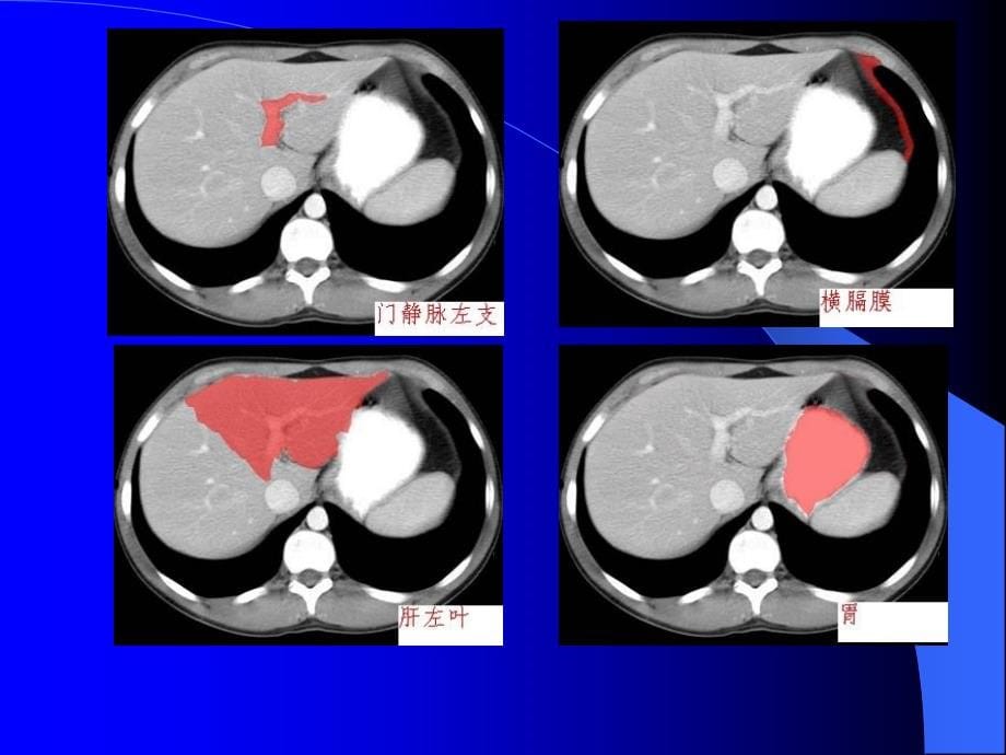 腹部CT诊断最新完整版本.ppt_第5页