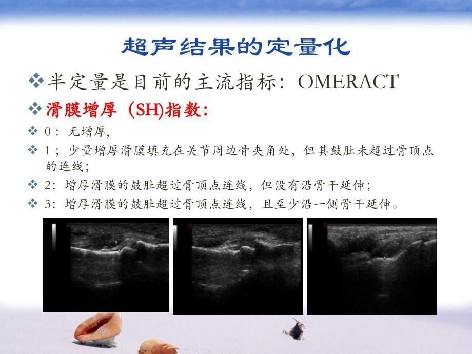 类风湿关节炎超声评估完整版本.ppt_第5页