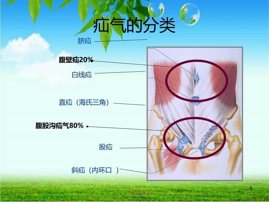 腹外疝病人的护理医学PPT课件.ppt_第5页