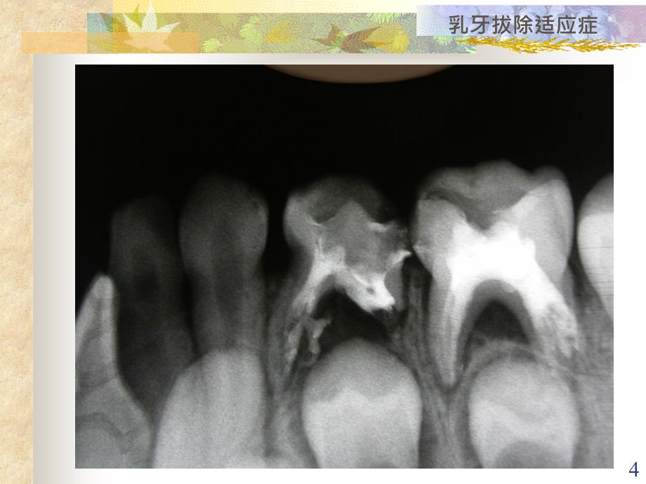 乳牙和年轻恒牙的拔除PPT课件.ppt_第4页