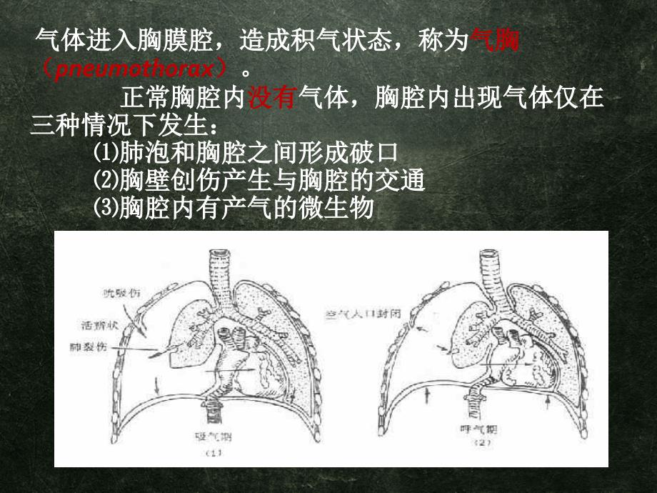 胸腔引流PPT课件.ppt_第4页